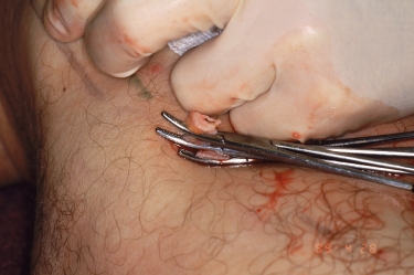 Access of the vein