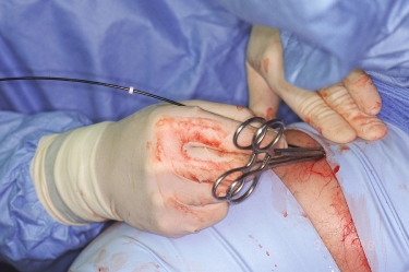 Insertion of the catheter